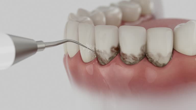 Trusted Dental Implants service in Bexley, OH - Dentist Open Now